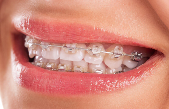 Керамические брекеты