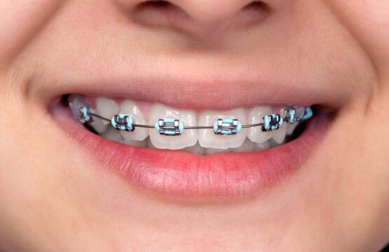 Брекеты BioMim