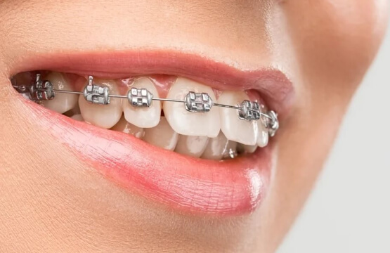 Металлические брекеты