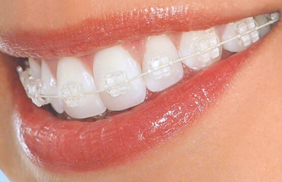 Сапфировые брекеты